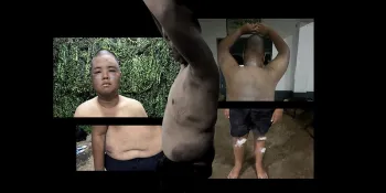 Vorapach Padmasakul's injuries (File photo)